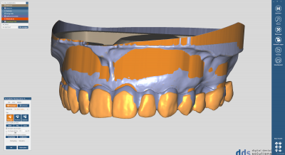 dds dentalCAD bite splint module