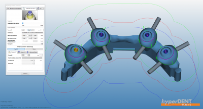 hyperDENT® implant module