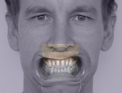 dds dentalCAD smile creator module
