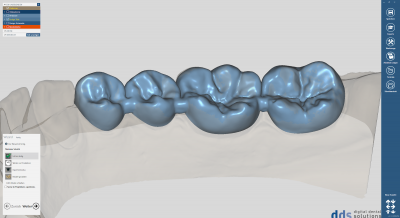 dds dentalCAD provisional module